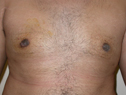 after male breast enlargement